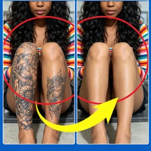 Pigmented permanent makeup tattoo removal Tattoo quick removal 1