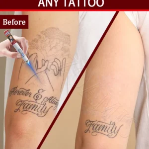 Nano laser tattooʀᴇᴍᴏᴠᴀʟ ᴘᴇɴ: Highly effective at removing pigmentation, faster recovery. Enjoy salon-quality technolo 1